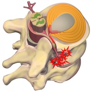 Subluxation: A power problem